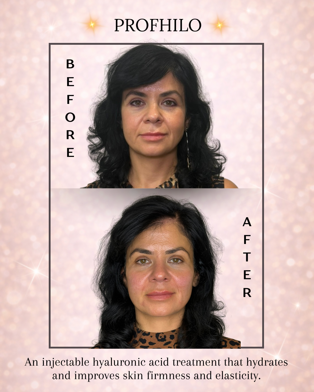 Profhilo before and after results at Beauty Art Aesthetics