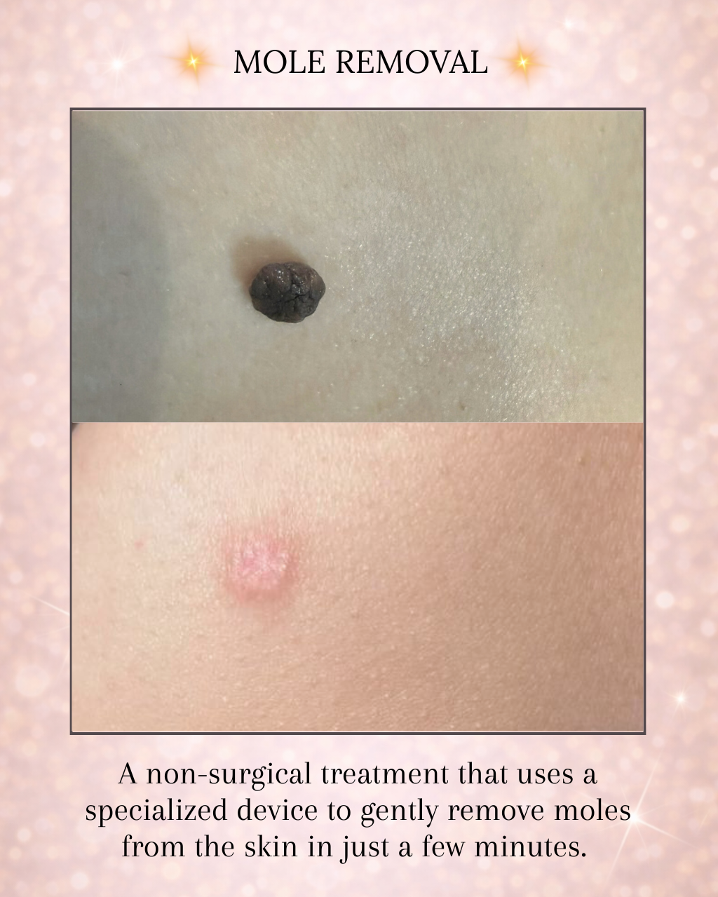 Mole removal before and after results at Beauty Art Aesthetics