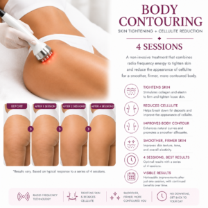Body Contouring Treatment (Skin Tightening & Cellulite Reduction) – 4 Sessions